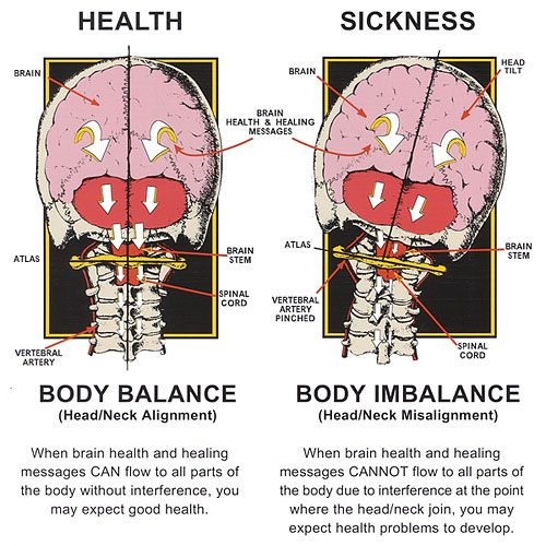 Cervical vertebrae misaligned symptoms